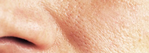 laser-skin-treatment-open-pores-singapore-aesthetic-clinic