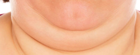 onlisculpt-aestheties-treatment-singapore-double-chin-oc2
