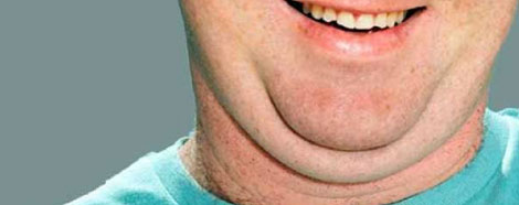 onlisculpt-aestheties-treatment-singapore-double-chin-oc3