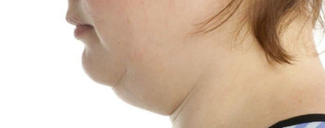 onlisculpt-aestheties-treatment-singapore-double-chin-oc4