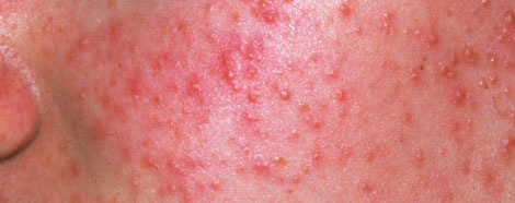 PRO-YELLOW-LASER-ACNE-aestheties-treatment-singapore-acne-oc1