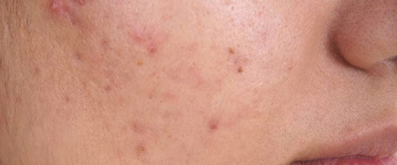 laser-skin-carbonado-aestheties-treatment-singapore-clinic-pimple-oc1