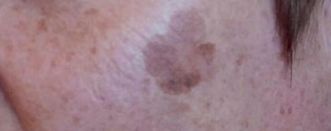 onlifreez-aestheties-treatment-singapore-clinic-pigmentation-skin-tag-removal-oc4-1.jpg